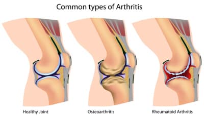 Arthritis of the Knee, Knee Injuries