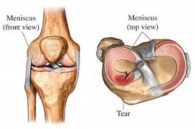 Meniscus Tear, Knee Injuries