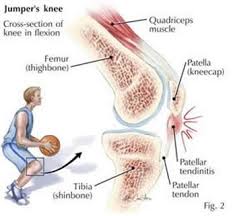Jumper's Knee, Knee Injuries
