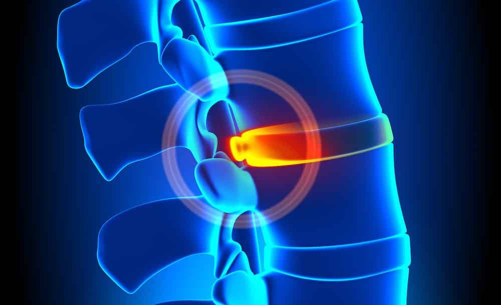 Bulging Disc Degeneration - Spine problem, Disc Injuries, Walkley Chiropractic Group, Bunbury Chiropractor, Chiropractor Bunbury