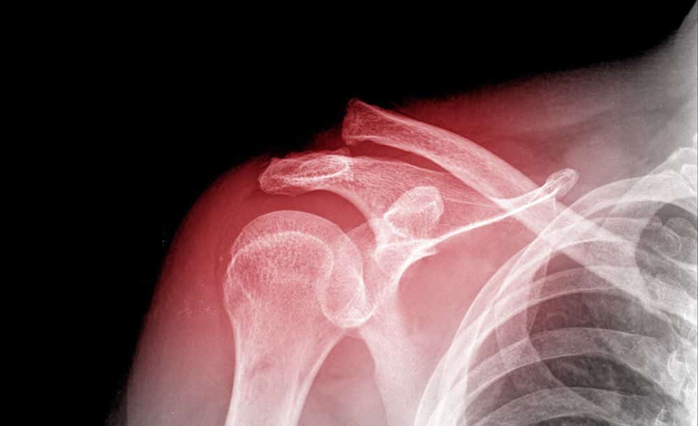 X-ray of human shoulder, Shoulder Injuries, Walkley Chiropractic Clinic, Bunbury, Western Australia
